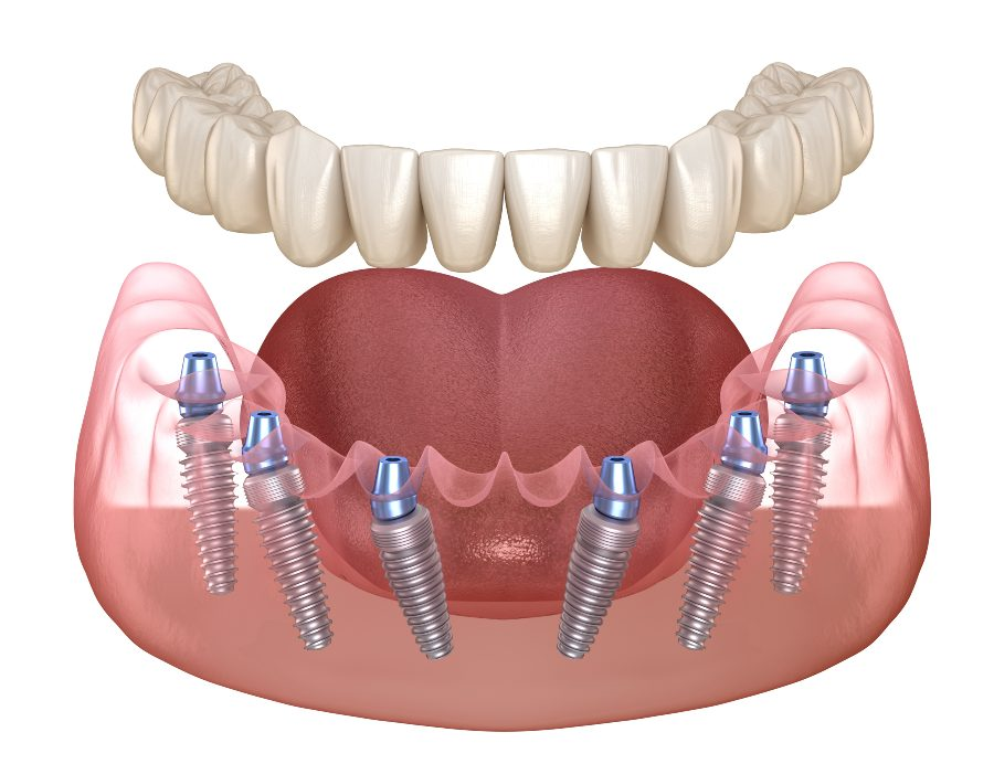 Stabili Teeth Mob 2 The 3 on 6 Dental Implantation Method in Turkey