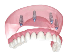 Stabili Teeth Mob 1 image 6 1