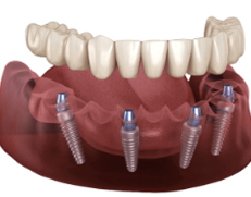 Stabili Teeth Mob 3 image 6